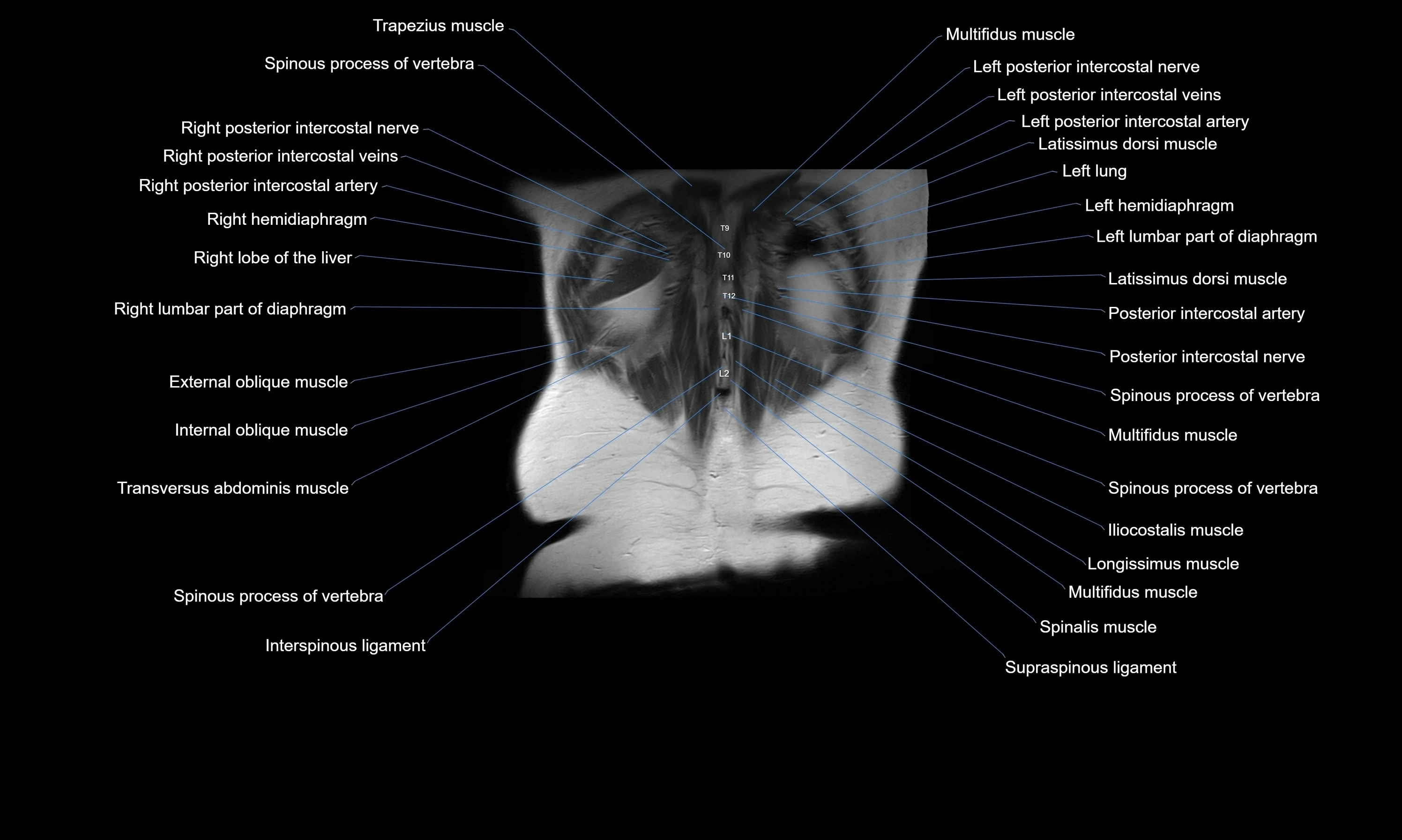 MRI Abdomen axial cross sectional anatomy radiology  image-img-00001-00053.webp